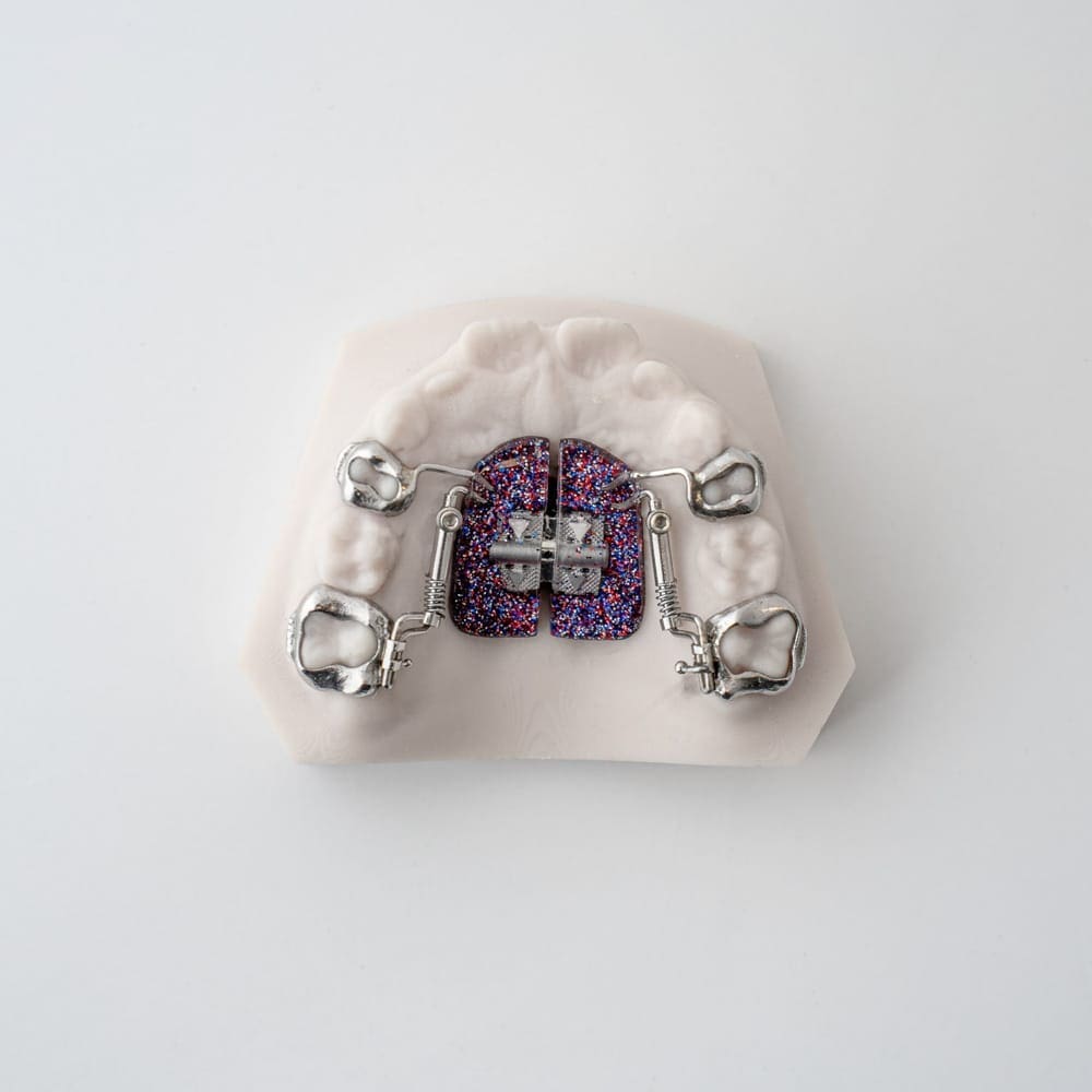 Distalization | ODL Orthodontic Labs