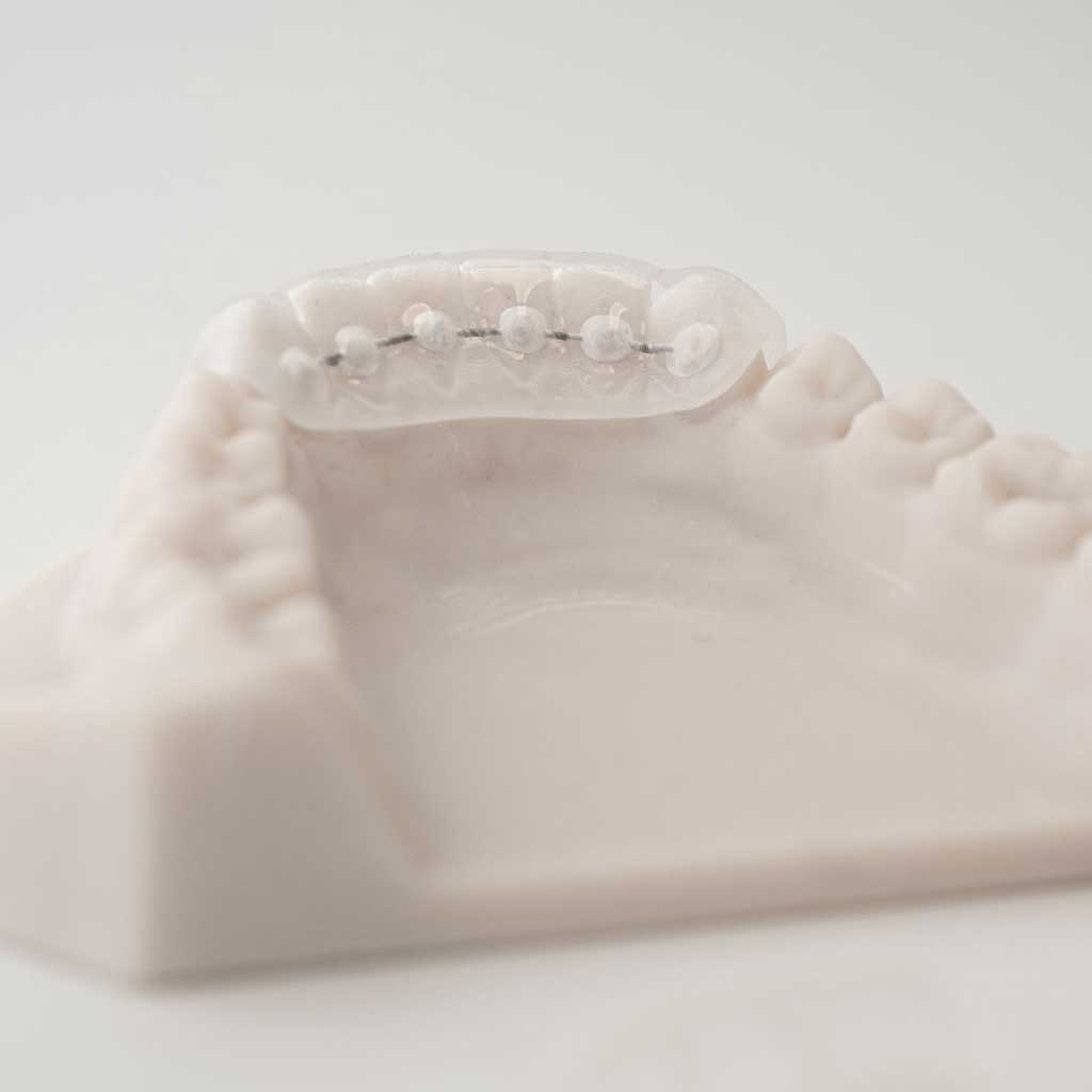 Fixed Lingual Retainers | ODL Orthodontic Labs