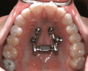 MASPE-zero-featured-image