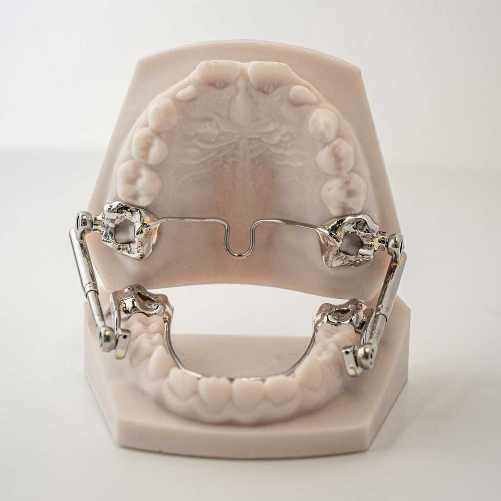 Digital Deprogramming Splint | ODL Orthodontic Labs