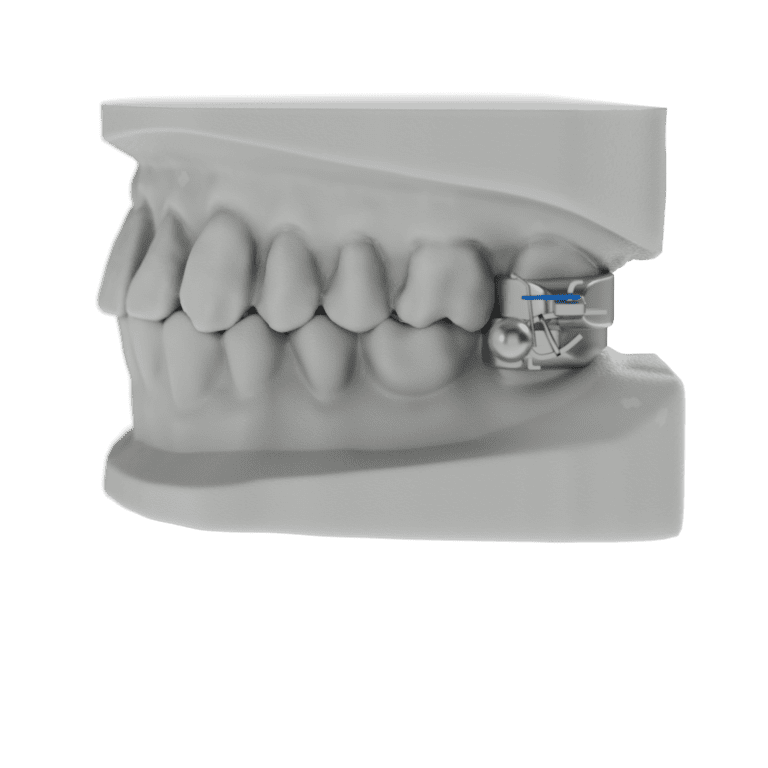 3 Way Appliance ODL Orthodontic Labs