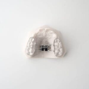 ODL Products 2024 Bonded RPE (Rapid Palatal Expander) 1