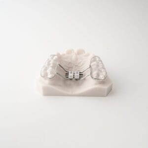 ODL Products 2024 Bonded RPE (Rapid Palatal Expander) 3