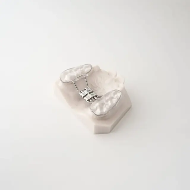 Palatal Expansion | ODL Orthodontic Labs