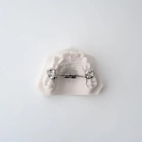 Compact RPE (Rapid Palatal Expander) | ODL Orthodontic Labs