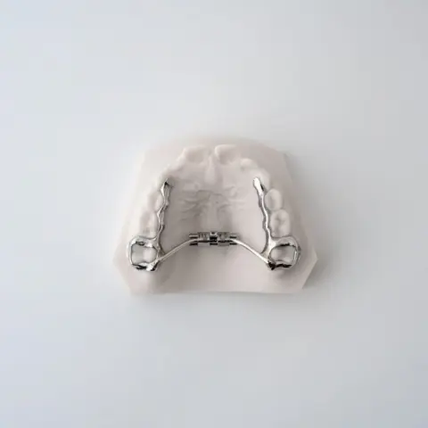 Compact RPE (Rapid Palatal Expander) | ODL Orthodontic Labs