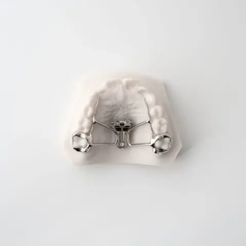 Fan RPE (Rapid Palatal Expander) | ODL Orthodontic Labs