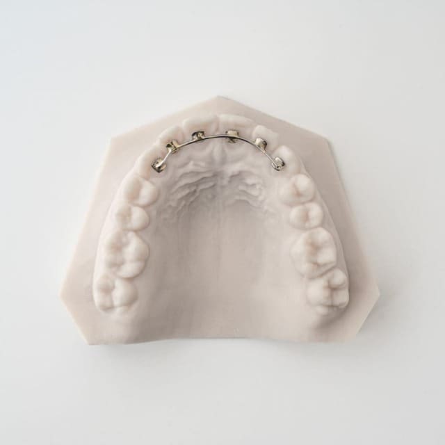 Fixed Lingual Retainers | ODL Orthodontic Labs