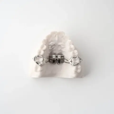 TAD Appliances for Airway Expansion | ODL Orthodontic Labs