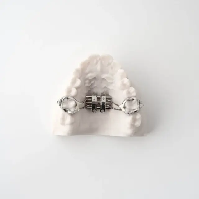 TAD Appliances for Airway Expansion | ODL Orthodontic Labs