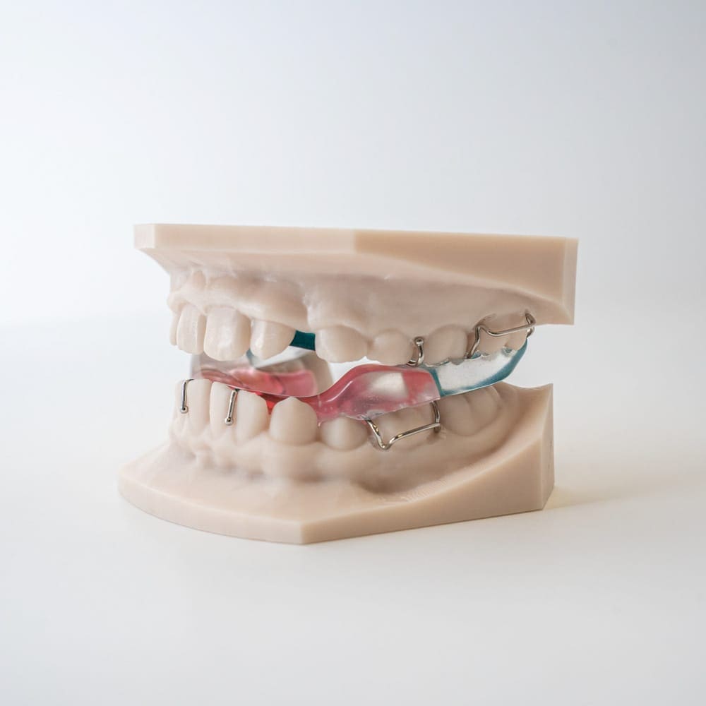 Digital Deprogramming Splint | ODL Orthodontic Labs