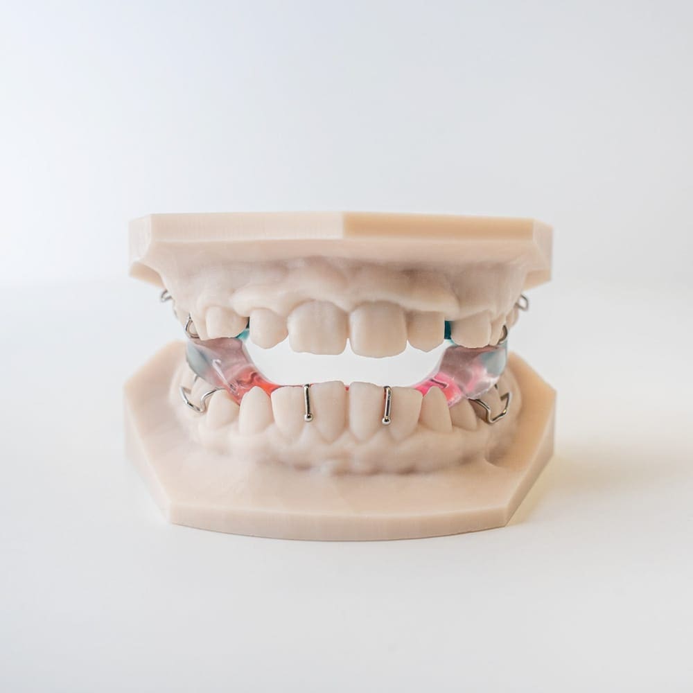 Digital Deprogramming Splint | ODL Orthodontic Labs