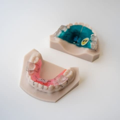 Digital Deprogramming Splint | ODL Orthodontic Labs