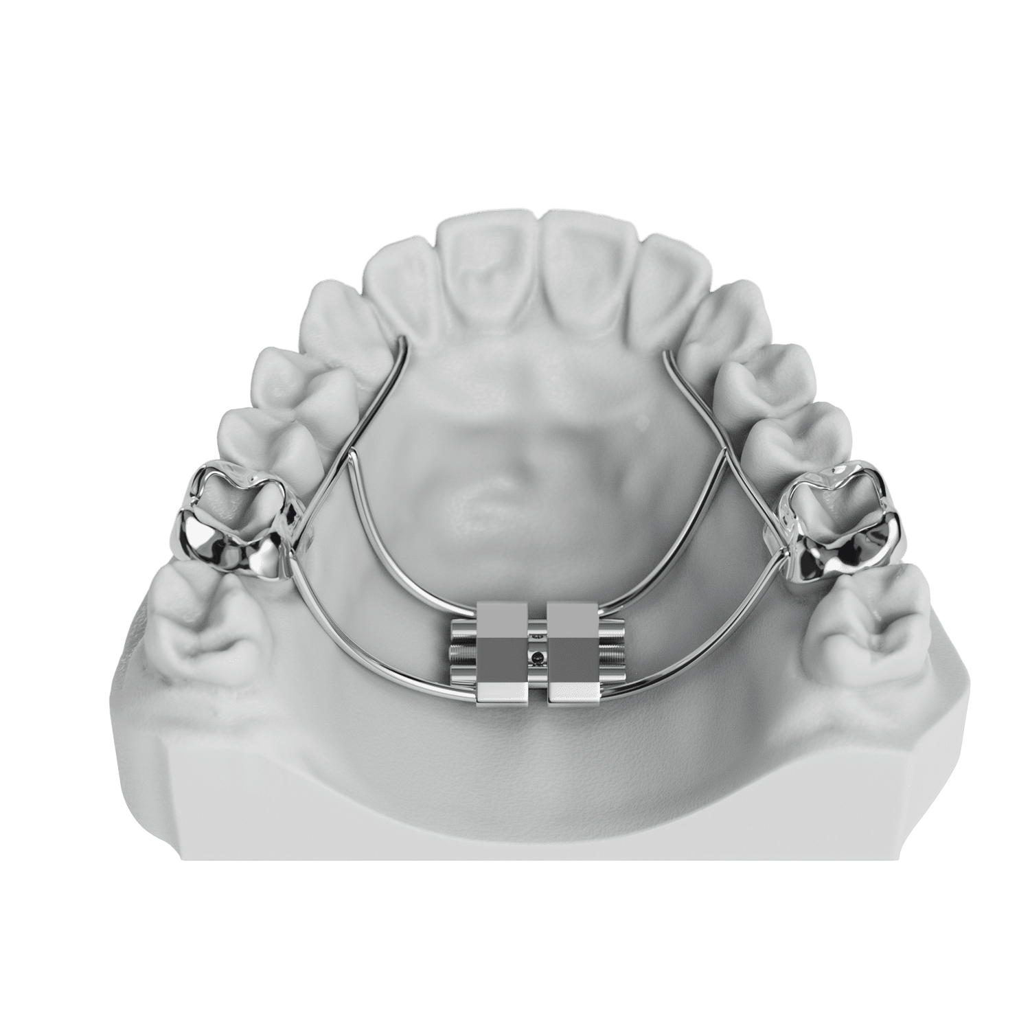 Bonded RPE (Rapid Palatal Expander) ODL Orthodontic Labs