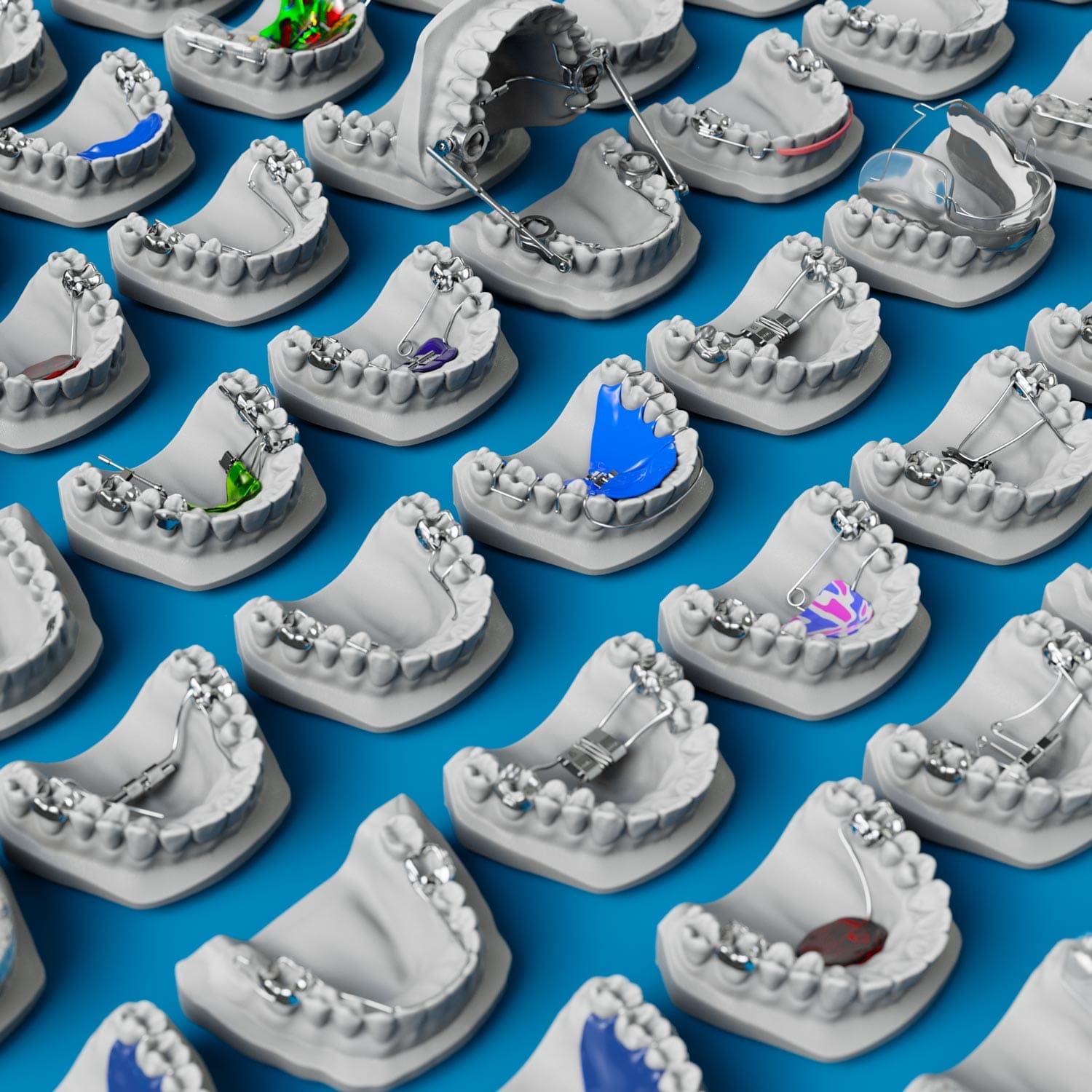 Modified Thereoux Rtainer Theroux Phase 1 Retainer | ODL Orthodontic Labs