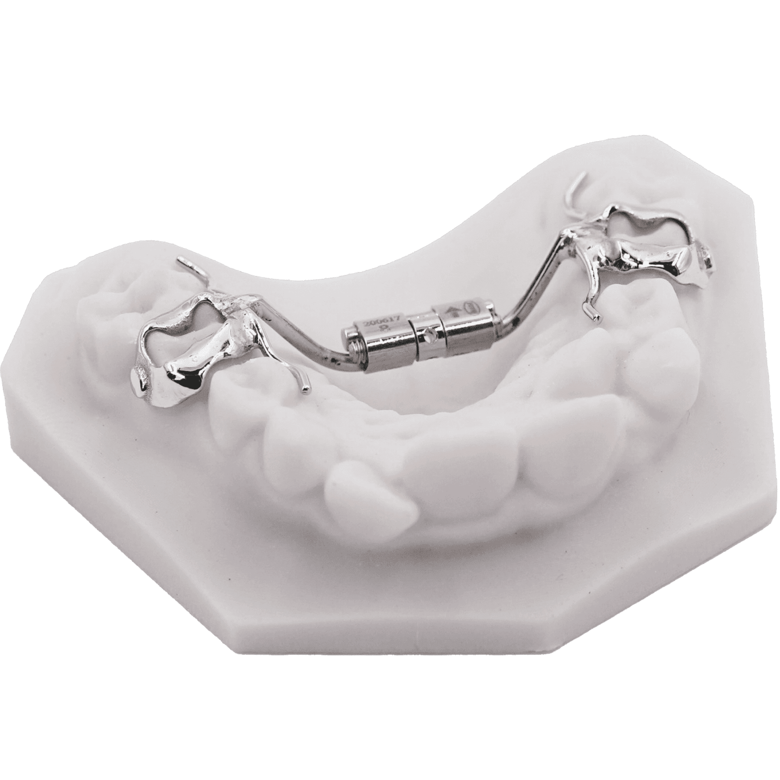 Infinity RPE | Innovative 3D-Printed Rapid Palatal Expanders