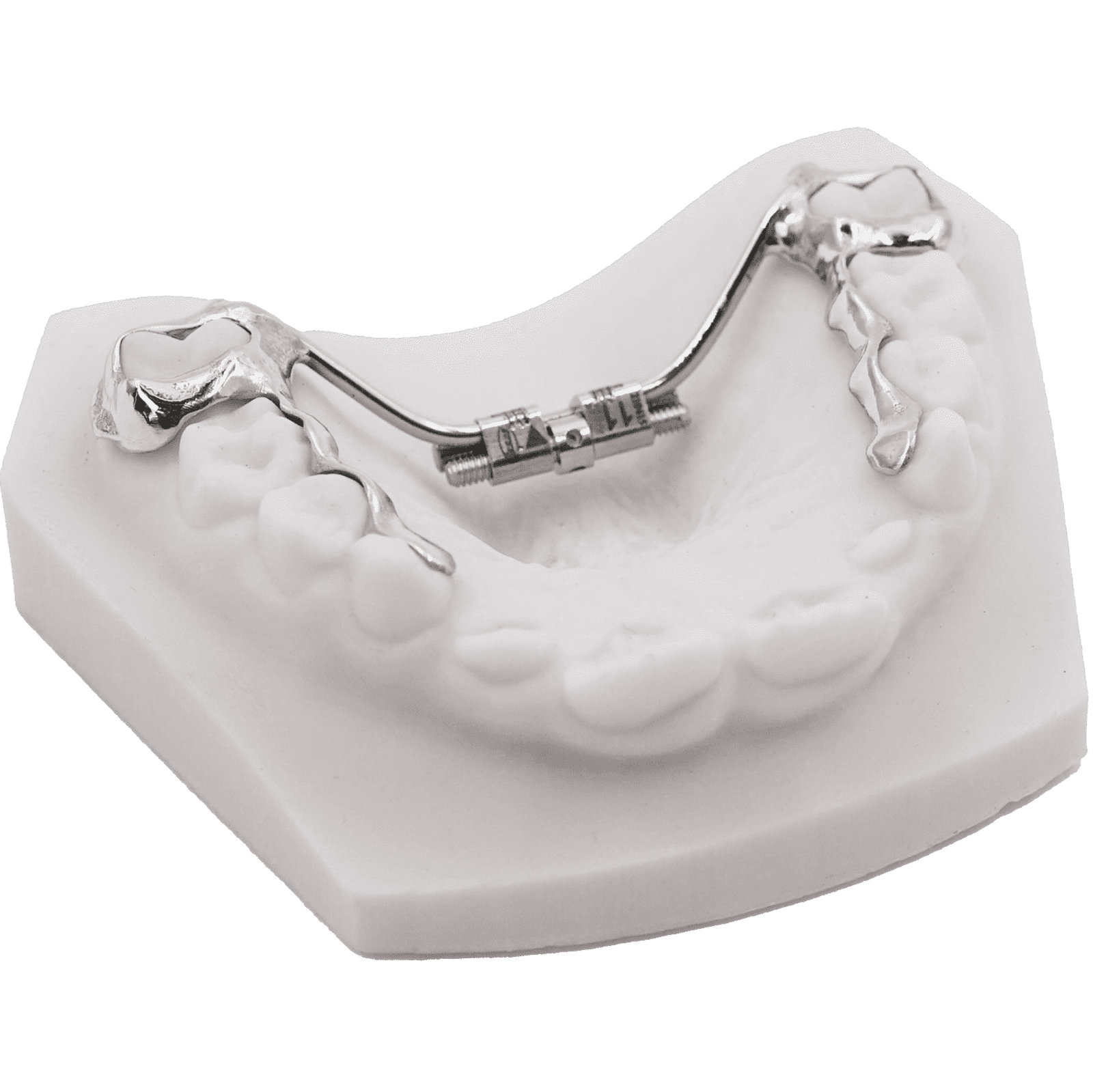 Infinity RPE | Innovative 3D-Printed Rapid Palatal Expanders