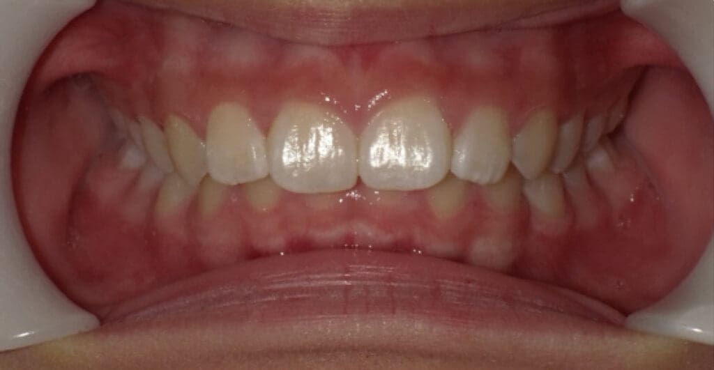 odl casper patient 3 teeth before