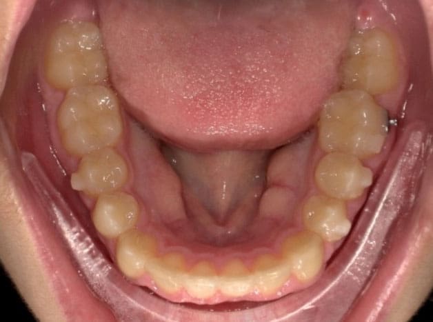 odl vivid patient after photo bottom