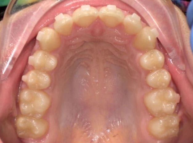 odl vivid patient after photo top