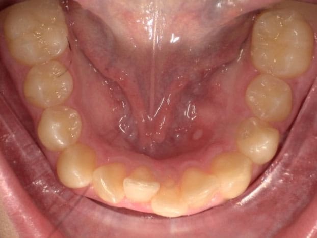 odl vivid patient before photo bottom